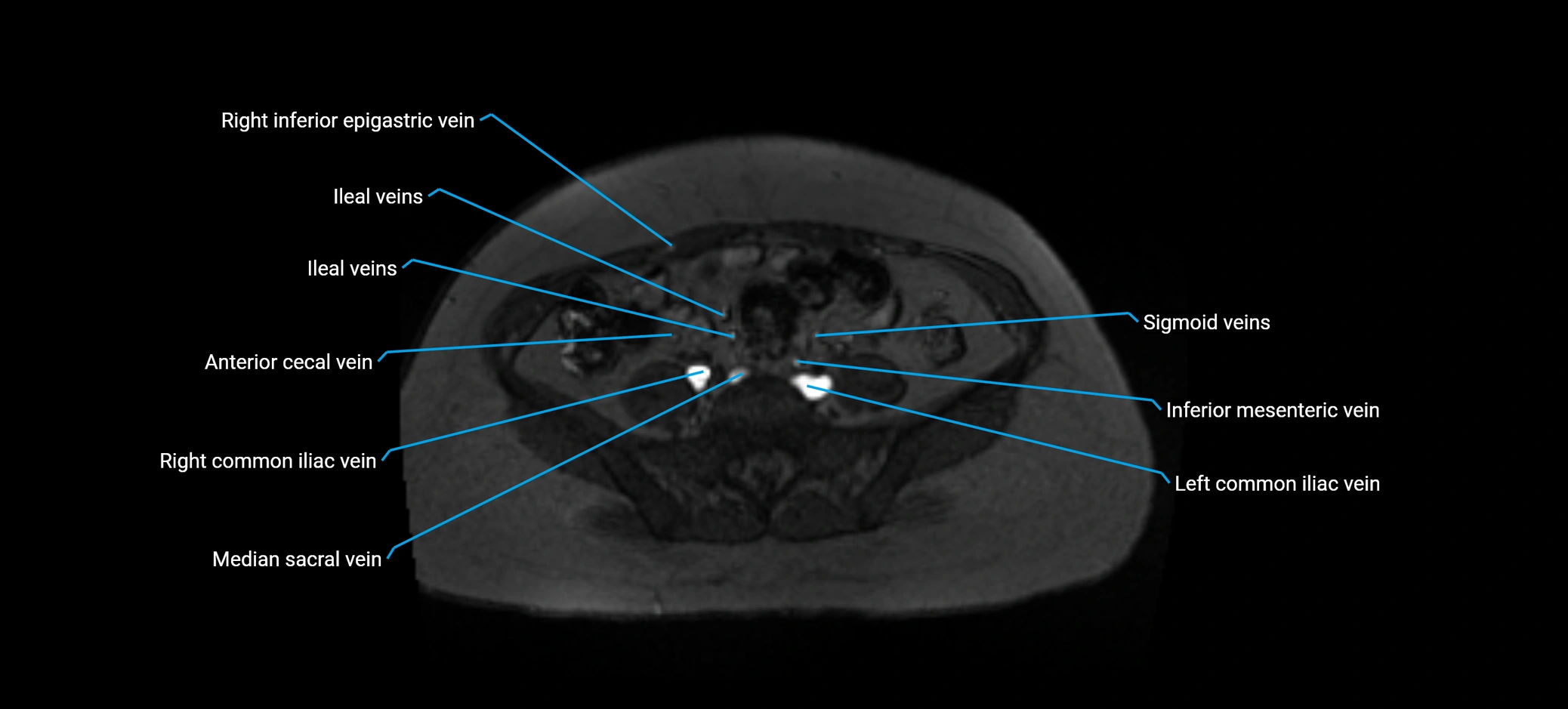 MRV abdomen pelvis & lower limb axial cross sectional anatomy labelled MRI image 128 (1).webp